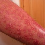 Dermatitis herpetiforme