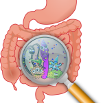 Enfermedad de Crohn