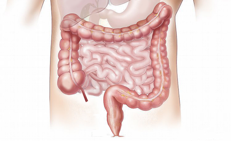 Colostomía