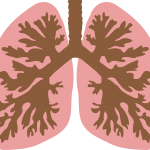 Derrame pleural