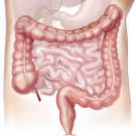 Ileostomía