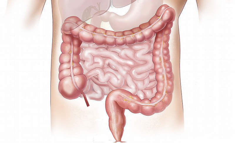 Ileostomía