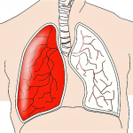 Enfisema