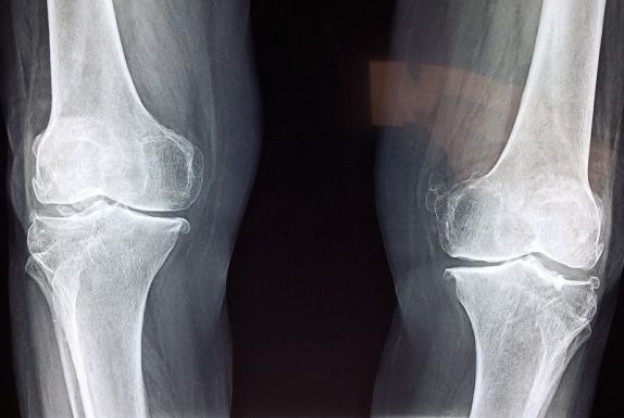 Cóndilo | Qué es, ubicación, afección, fractura, tratamiento